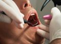 Impacted Wisdom Teeth