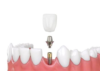 Types of Dental Implants