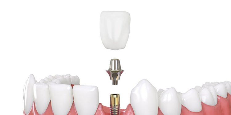Types of Dental Implants