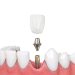 Types of Dental Implants