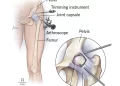 Hip Arthroscopy Surgery: The Most Efficient Treatment for a Hip Labral Tear