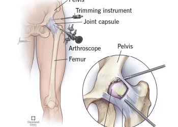 Hip Arthroscopy Surgery: The Most Efficient Treatment for a Hip Labral Tear
