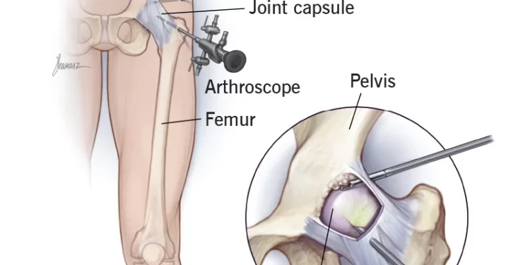 Hip Arthroscopy Surgery: The Most Efficient Treatment for a Hip Labral Tear