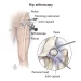 Hip Arthroscopy Surgery: The Most Efficient Treatment for a Hip Labral Tear