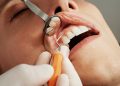 What are the requirements for veneers