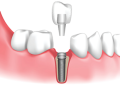 9+1 Advantages of Dental Implants