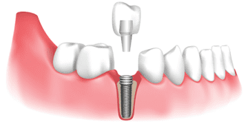 9+1 Advantages of Dental Implants