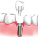 9+1 Advantages of Dental Implants