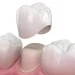 Restoring Strength and Beauty: Understanding Dental Crowns