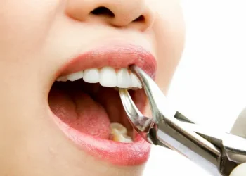 Understanding Dental Extractions: What You Need to Know