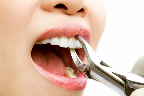 Understanding Dental Extractions: What You Need to Know